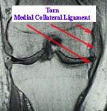 torn medial collateral ligament